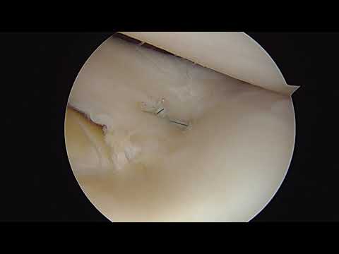 Arthroscopic bucket-handle lateral meniscal repair by Dr. Dold (all-inside technique)