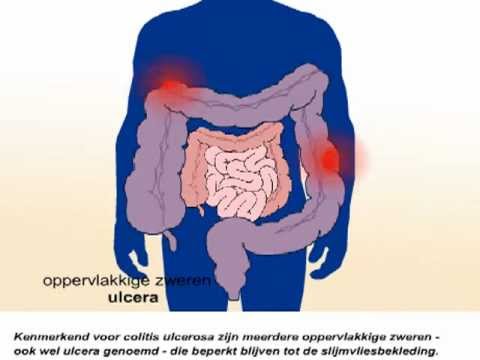 Colitis ulcerosa - Wat zijn de symptomen?
