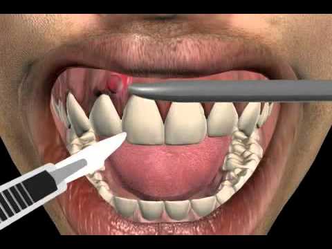 How to treat a tooth abscess