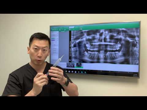 Infections after Wisdom Teeth Removal