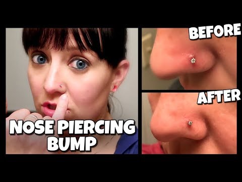 How To Get Rid Of A Nose Piercing Bump FAST! | (Keloid)  📍 How To With Kristin