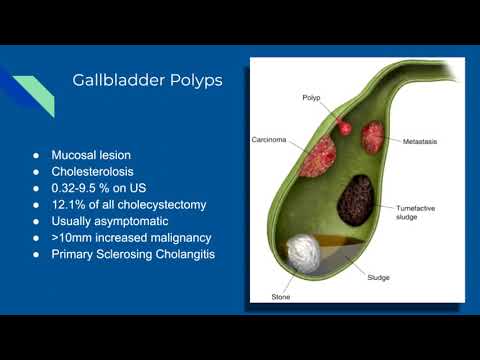 Sonoquickies - Gallbladder Polyps